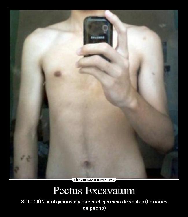 Pectus Excavatum - SOLUCIÓN: ir al gimnasio y hacer el ejercicio de velitas (flexiones de pecho)