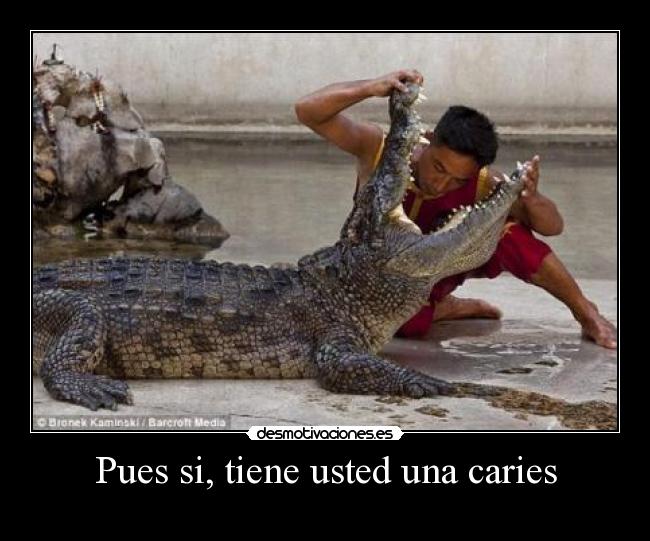 Pues si, tiene usted una caries -