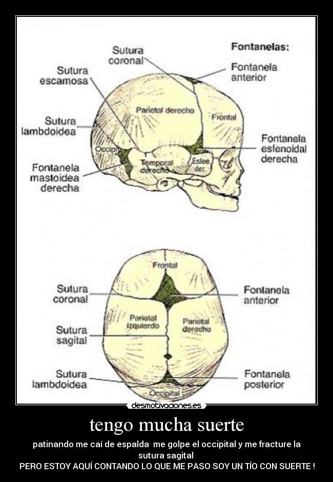 tengo mucha suerte - patinando me caí de espalda me golpe el occipital y me fracture la sutura sagital
PERO ESTOY AQUÍ CONTANDO LO QUE ME PASO SOY UN TÍO CON SUERTE !