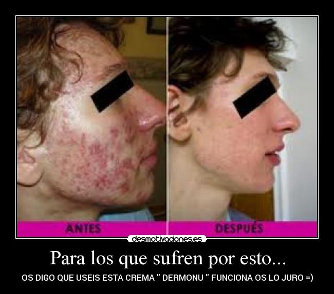 Para los que sufren por esto... - OS DIGO QUE USEIS ESTA CREMA  DERMONU  FUNCIONA OS LO JURO =)