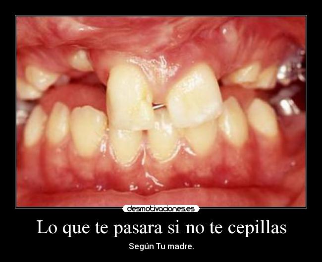 Lo que te pasara si no te cepillas - Según Tu madre.