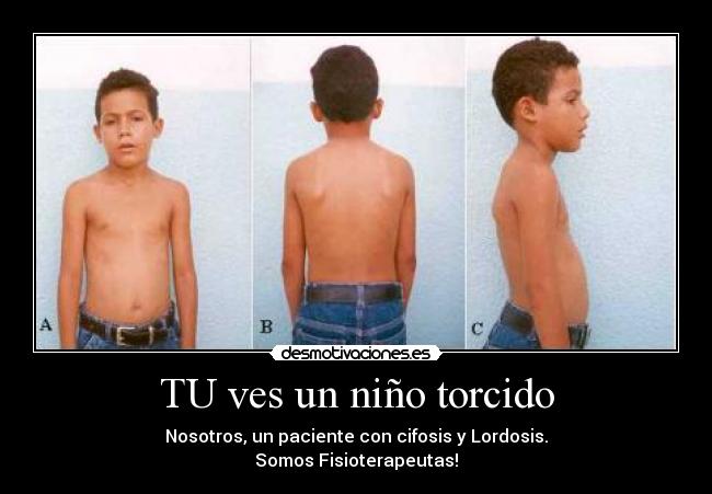 TU ves un niño torcido - Nosotros, un paciente con cifosis y Lordosis.
Somos Fisioterapeutas!