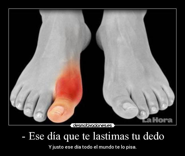 - Ese día que te lastimas tu dedo - Y justo ese día todo el mundo te lo pisa.