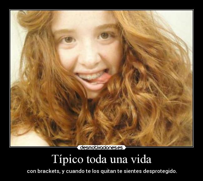 Típico toda una vida - con brackets, y cuando te los quitan te sientes desprotegido.