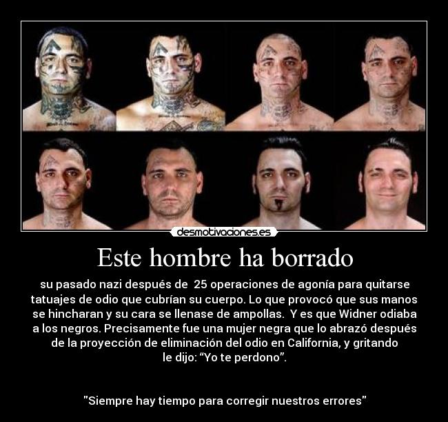 Este hombre ha borrado - su pasado nazi después de 25 operaciones de agonía para quitarse
tatuajes de odio que cubrían su cuerpo. Lo que provocó que sus manos
se hincharan y su cara se llenase de ampollas. Y es que Widner odiaba
a los negros. Precisamente fue una mujer negra que lo abrazó después
de la proyección de eliminación del odio en California, y gritando
le dijo: “Yo te perdono”.
Siempre hay tiempo para corregir nuestros errores