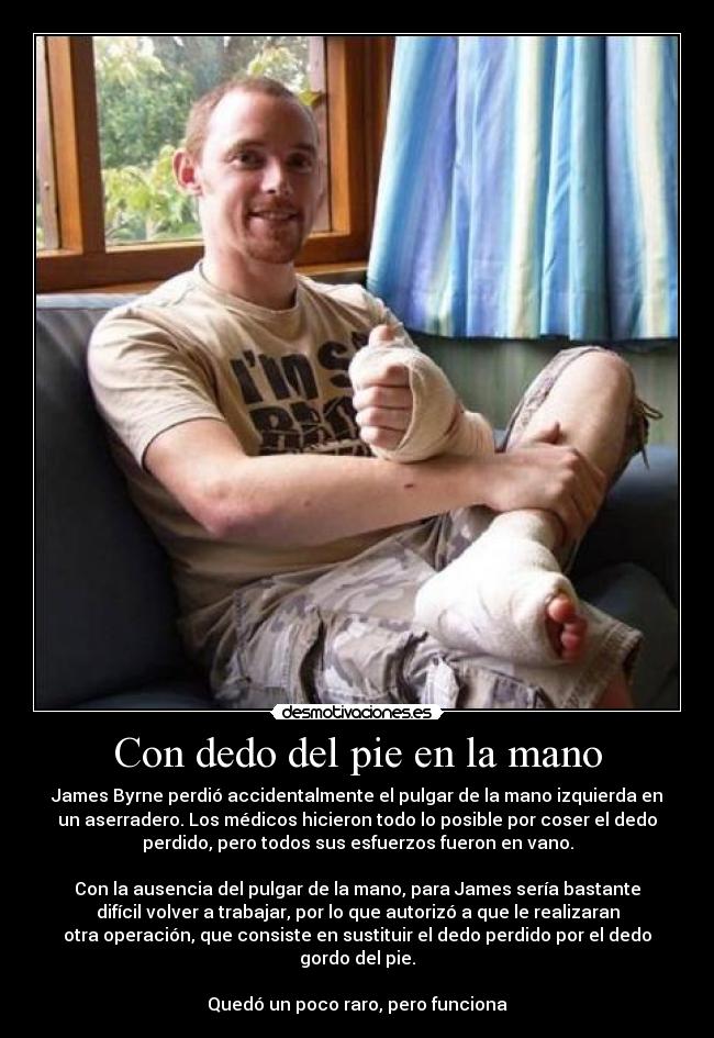 Con dedo del pie en la mano - James Byrne perdió accidentalmente el pulgar de la mano izquierda en
un aserradero. Los médicos hicieron todo lo posible por coser el dedo
perdido, pero todos sus esfuerzos fueron en vano.

Con la ausencia del pulgar de la mano, para James sería bastante
difícil volver a trabajar, por lo que autorizó a que le realizaran
otra operación, que consiste en sustituir el dedo perdido por el dedo
gordo del pie.

Quedó un poco raro, pero funciona