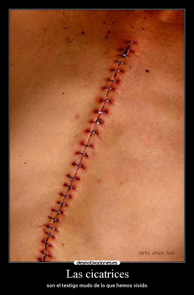 Las cicatrices -