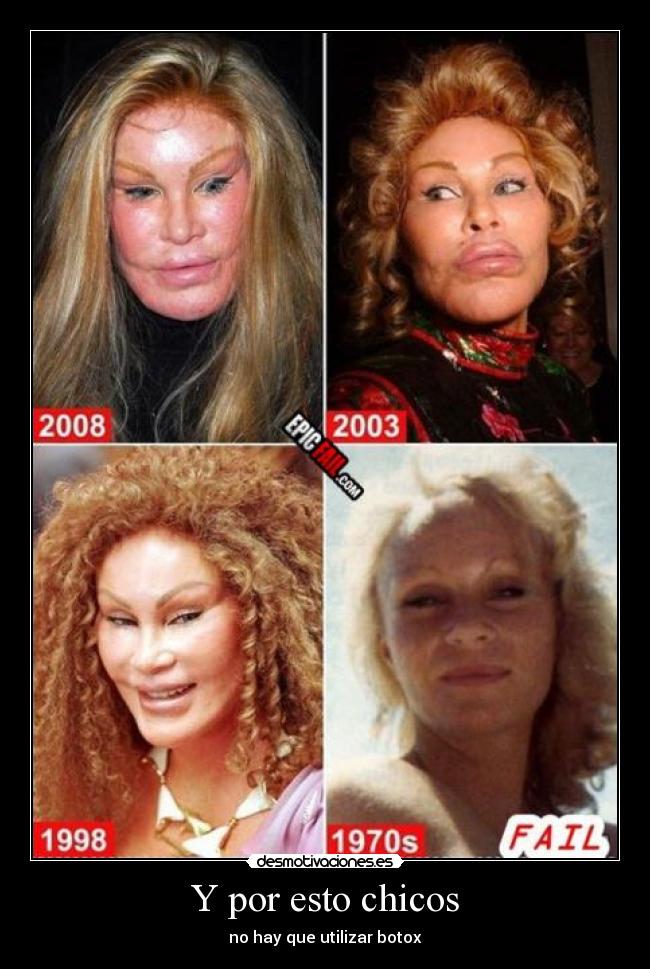 Y por esto chicos - no hay que utilizar botox