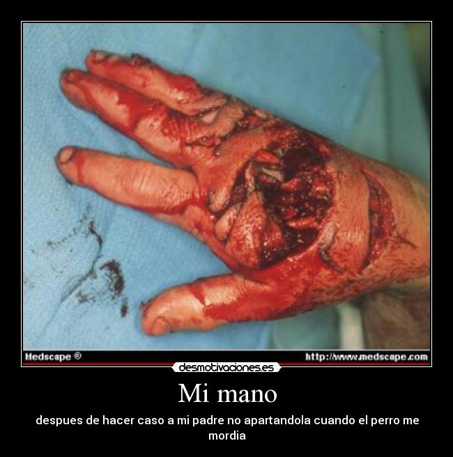 Mi mano - despues de hacer caso a mi padre no apartandola cuando el perro me mordia