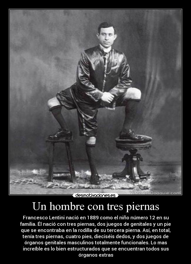Un hombre con tres piernas - Francesco Lentini nació en 1889 como el niño número 12 en su
familia. Él nació con tres piernas, dos juegos de genitales y un pie
que se encontraba en la rodilla de su tercera pierna. Así, en total,
tenía tres piernas, cuatro pies, dieciséis dedos, y dos juegos de
órganos genitales masculinos totalmente funcionales. Lo mas
increíble es lo bien estructurados que se encuentran todos sus
órganos extras