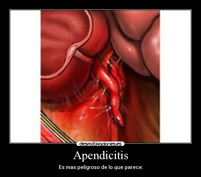 Apendicitis - Es mas peligroso de lo que parece.