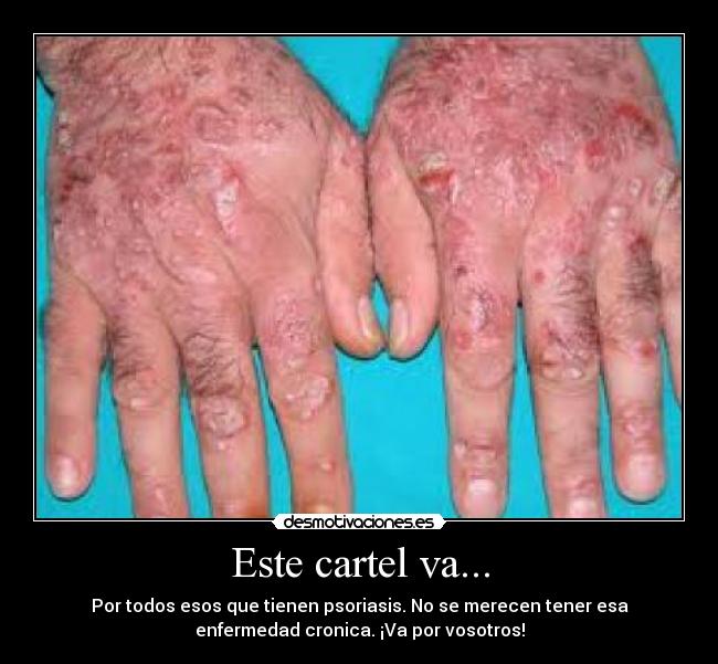 Este cartel va... - Por todos esos que tienen psoriasis. No se merecen tener esa
enfermedad cronica. ¡Va por vosotros!