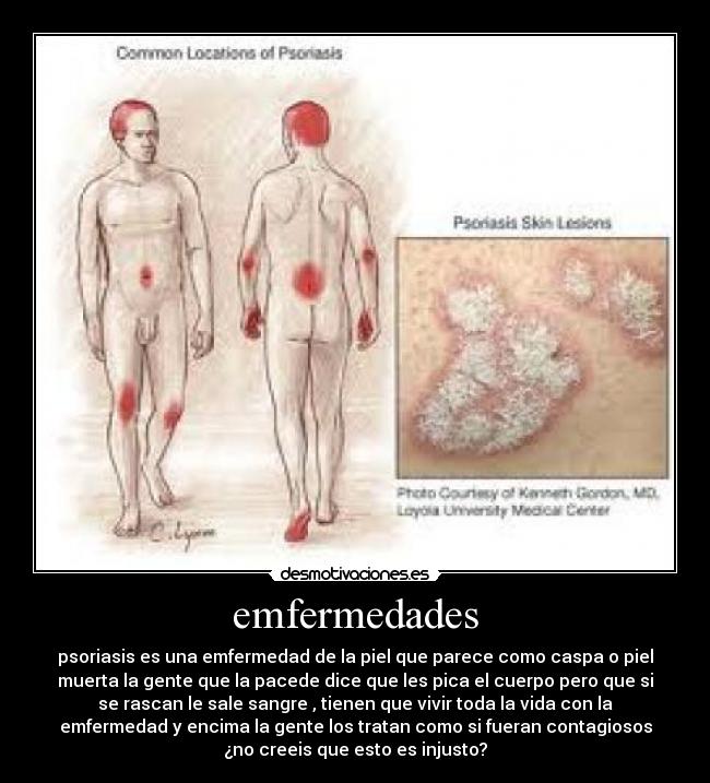 emfermedades - psoriasis es una emfermedad de la piel que parece como caspa o piel
muerta la gente que la pacede dice que les pica el cuerpo pero que si
se rascan le sale sangre , tienen que vivir toda la vida con la
emfermedad y encima la gente los tratan como si fueran contagiosos
¿no creeis que esto es injusto?