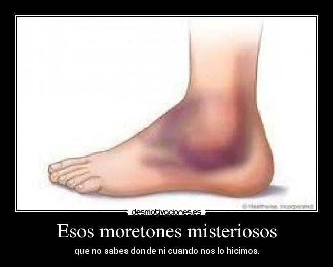 Esos moretones misteriosos - que no sabes donde ni cuando nos lo hicimos.