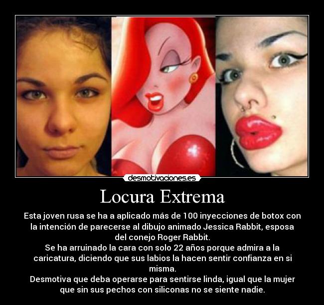 Locura Extrema - Esta joven rusa se ha a aplicado más de 100 inyecciones de botox con
la intención de parecerse al dibujo animado Jessica Rabbit, esposa
del conejo Roger Rabbit.
Se ha arruinado la cara con solo 22 años porque admira a la
caricatura, diciendo que sus labios la hacen sentir confianza en si
misma.
Desmotiva que deba operarse para sentirse linda, igual que la mujer
que sin sus pechos con siliconas no se siente nadie.