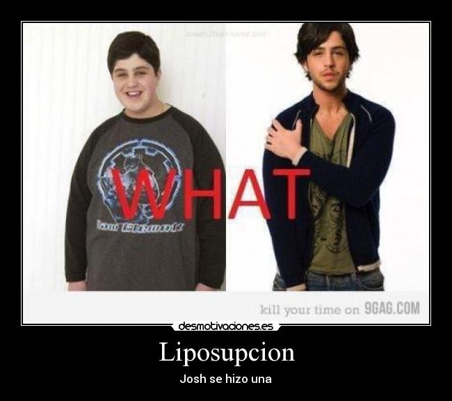 Liposupcion - Josh se hizo una