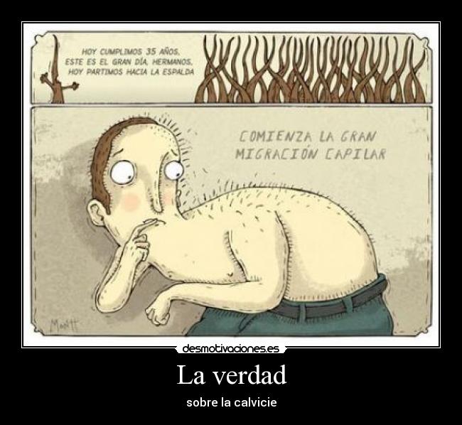 La verdad - sobre la calvicie