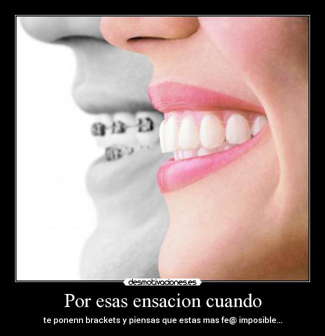 Por esas ensacion cuando - te ponenn brackets y piensas que estas mas fe@ imposible...