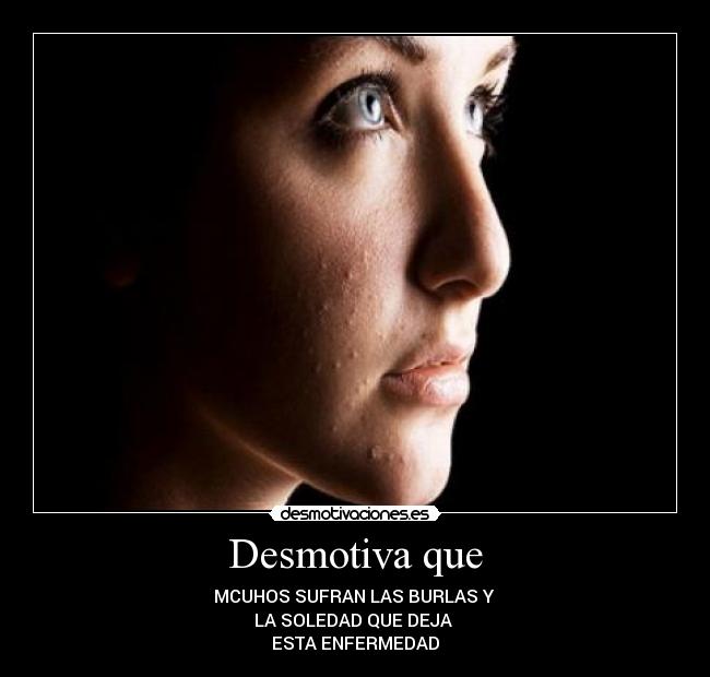 Desmotiva que - MCUHOS SUFRAN LAS BURLAS Y 
LA SOLEDAD QUE DEJA 
ESTA ENFERMEDAD