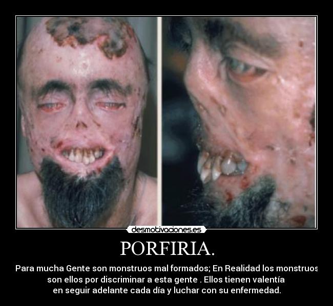 PORFIRIA. - Para mucha Gente son monstruos mal formados; En Realidad los monstruos
son ellos por discriminar a esta gente . Ellos tienen valentía 
en seguir adelante cada día y luchar con su enfermedad.