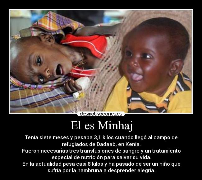 El es Minhaj - Tenía siete meses y pesaba 3,1 kilos cuando llegó al campo de
refugiados de Dadaab, en Kenia.
Fueron necesarias tres transfusiones de sangre y un tratamiento
especial de nutrición para salvar su vida.
En la actualidad pesa casi 8 kilos y ha pasado de ser un niño que
sufría por la hambruna a desprender alegría.