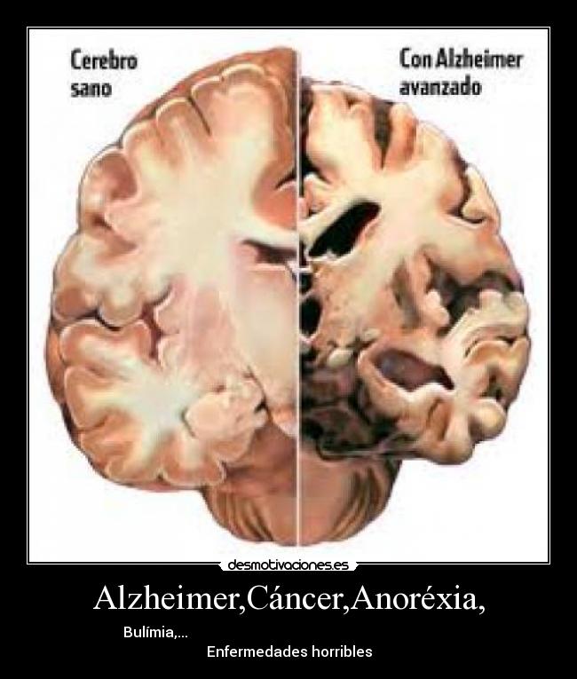 Alzheimer,Cáncer,Anoréxia, - Bulímia,...
Enfermedades horribles