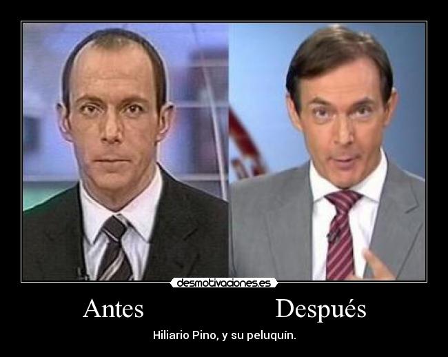 Antes                   Después - Hiliario Pino, y su peluquín.