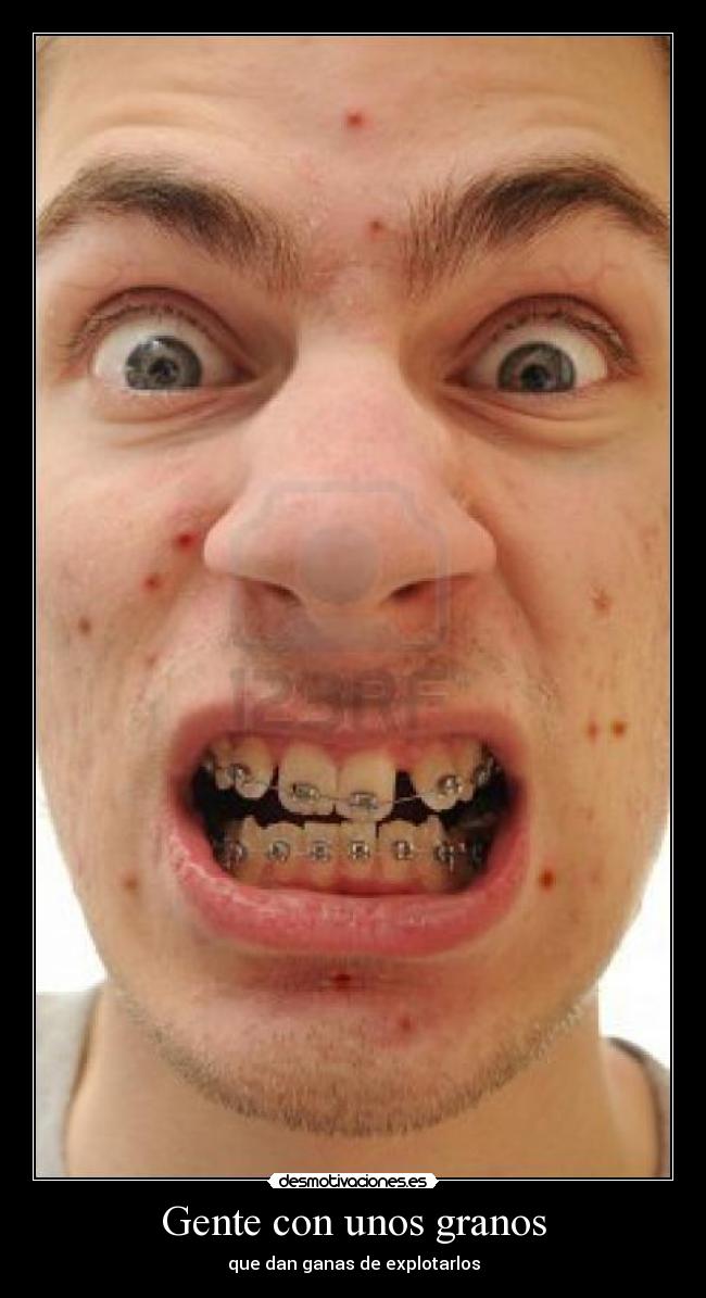 Gente con unos granos - que dan ganas de explotarlos