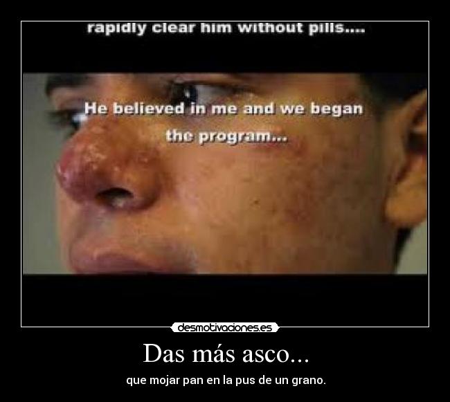 Das más asco... - que mojar pan en la pus de un grano.