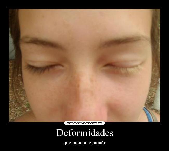 Deformidades -