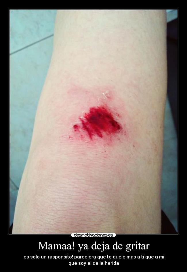 Mamaa! ya deja de gritar - es solo un rasponsito! pareciera que te duele mas a ti que a mi
que soy el de la herida