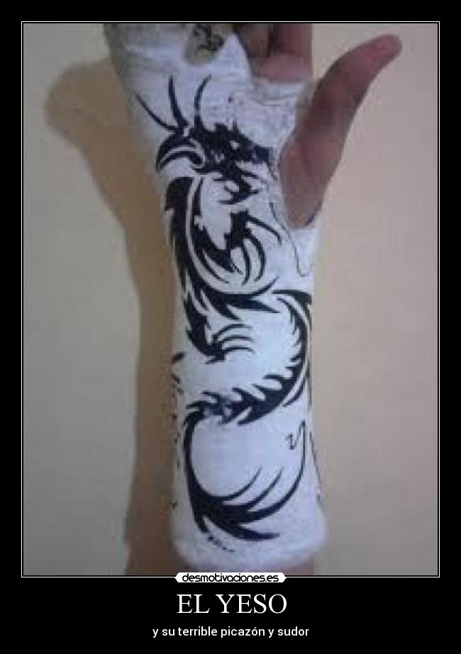 EL YESO - y su terrible picazón y sudor
