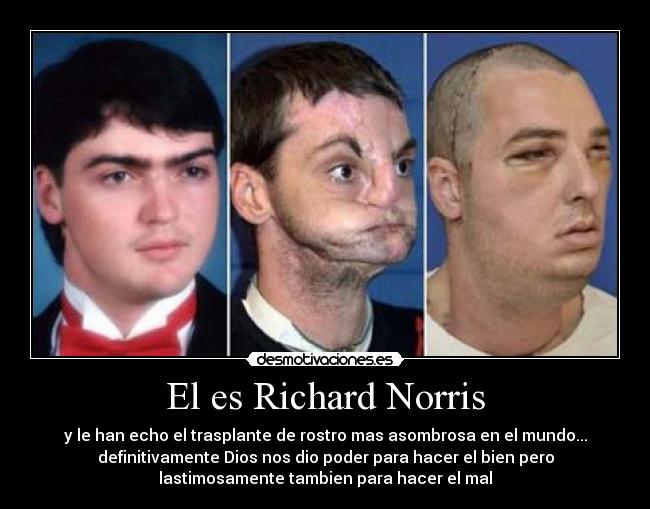 El es Richard Norris - y le han echo el trasplante de rostro mas asombrosa en el mundo...
definitivamente Dios nos dio poder para hacer el bien pero
lastimosamente tambien para hacer el mal