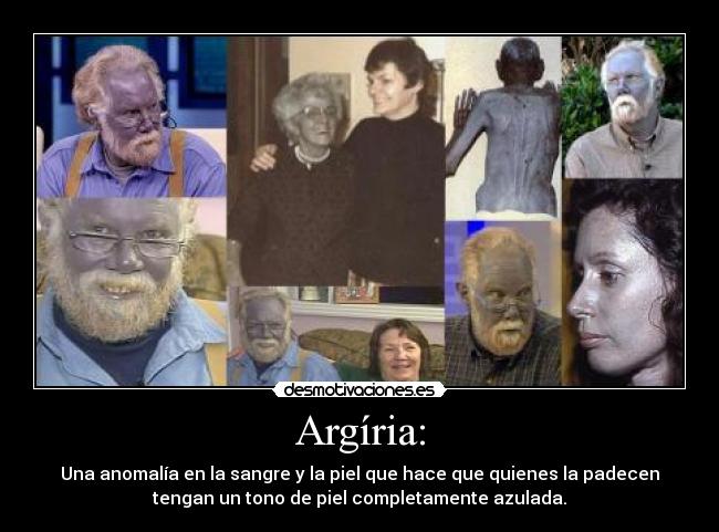 Argíria: - Una anomalía en la sangre y la piel que hace que quienes la padecen
tengan un tono de piel completamente azulada.