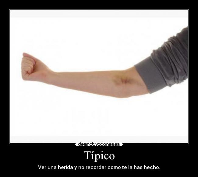 Típico - Ver una herida y no recordar como te la has hecho.