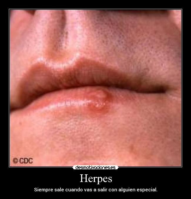 Herpes - Siempre sale cuando vas a salir con alguien especial.