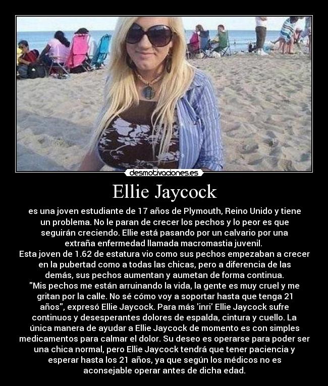 Ellie Jaycock - es una joven estudiante de 17 años de Plymouth, Reino Unido y tiene
un problema. No le paran de crecer los pechos y lo peor es que
seguirán creciendo. Ellie está pasando por un calvario por una
extraña enfermedad llamada macromastia juvenil. 
Esta joven de 1.62 de estatura vio como sus pechos empezaban a crecer
en la pubertad como a todas las chicas, pero a diferencia de las
demás, sus pechos aumentan y aumetan de forma continua.
Mis pechos me están arruinando la vida, la gente es muy cruel y me
gritan por la calle. No sé cómo voy a soportar hasta que tenga 21
años, expresó Ellie Jaycock. Para más inri Ellie Jaycock sufre
continuos y desesperantes dolores de espalda, cintura y cuello. La
única manera de ayudar a Ellie Jaycock de momento es con simples
medicamentos para calmar el dolor. Su deseo es operarse para poder ser
una chica normal, pero Ellie Jaycock tendrá que tener paciencia y
esperar hasta los 21 años, ya que según los médicos no es
aconsejable operar antes de dicha edad.