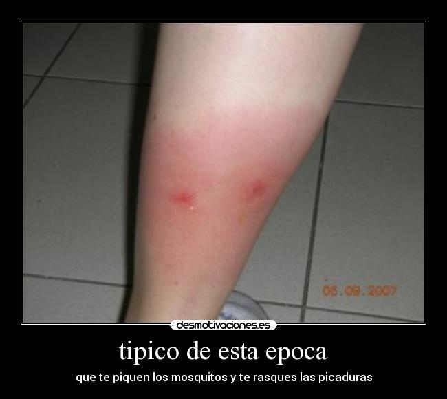 tipico de esta epoca - que te piquen los mosquitos y te rasques las picaduras
