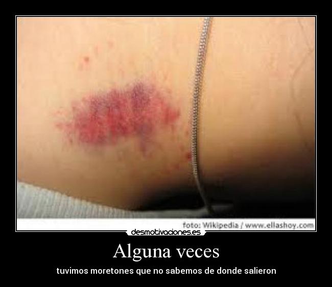 Alguna veces - tuvimos moretones que no sabemos de donde salieron