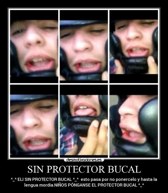 SIN PROTECTOR BUCAL - ^_^ ELI SIN PROTECTOR BUCAL ^_^  esto pasa por no ponercelo y hasta la
lengua mordía.NIÑOS PÓNGANSE EL PROTECTOR BUCAL ^_^