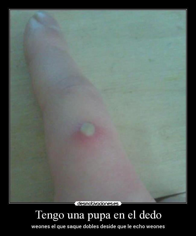 Tengo una pupa en el dedo - weones el que saque dobles deside que le echo weones