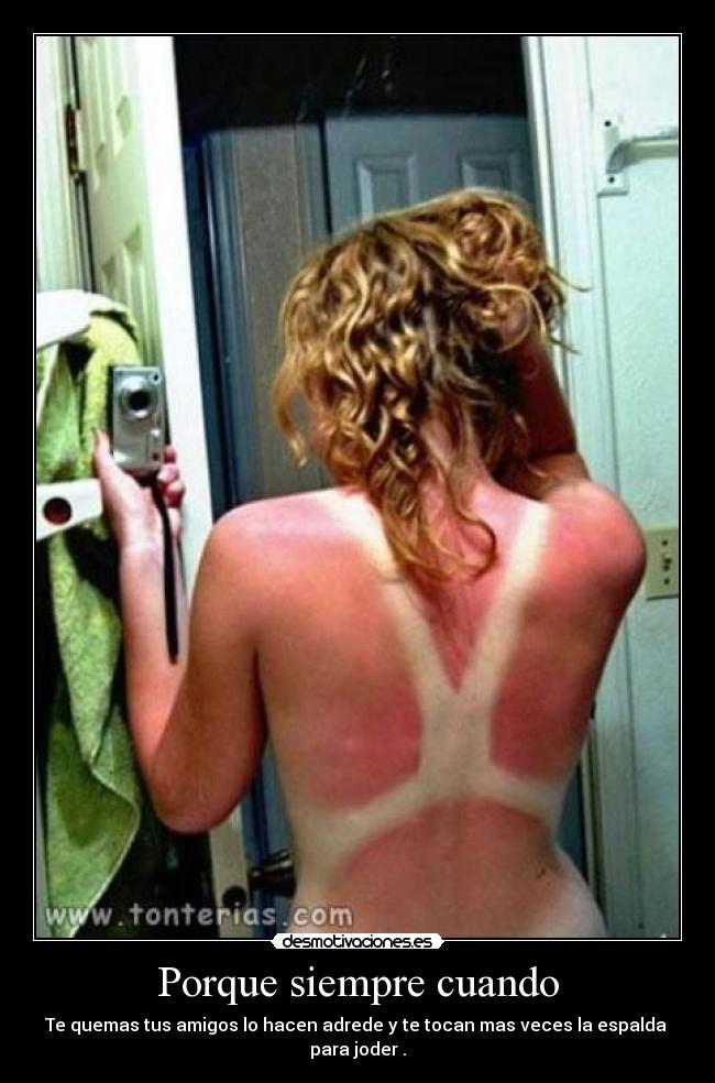 Porque siempre cuando - Te quemas tus amigos lo hacen adrede y te tocan mas veces la espalda para joder .