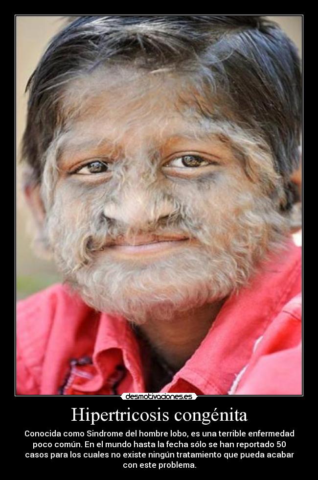 Hipertricosis congénita - Conocida como Sindrome del hombre lobo, es una terrible enfermedad
poco común. En el mundo hasta la fecha sólo se han reportado 50
casos para los cuales no existe ningún tratamiento que pueda acabar
con este problema.