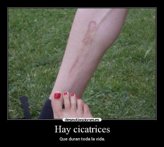Hay cicatrices - Que duran toda la vida.