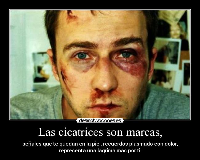 Las cicatrices son marcas, -