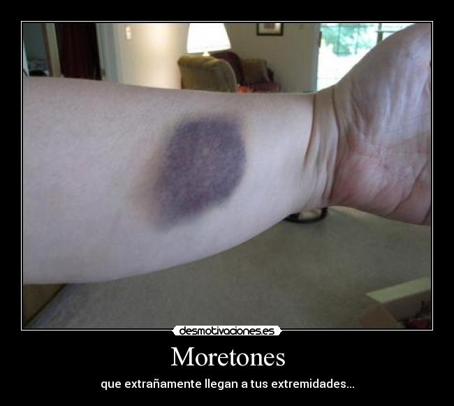 Moretones - que extrañamente llegan a tus extremidades...