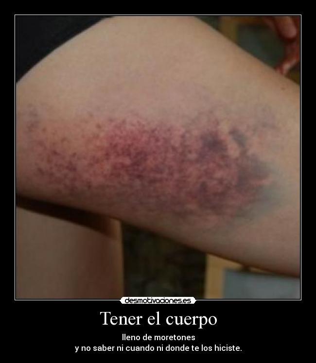 Tener el cuerpo - lleno de moretones
y no saber ni cuando ni donde te los hiciste.