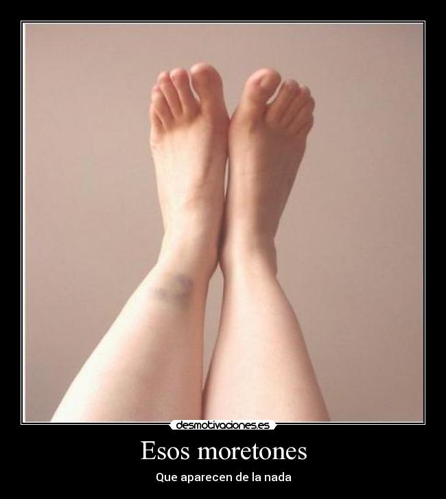 Esos moretones - 