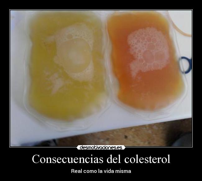 Consecuencias del colesterol - Real como la vida misma