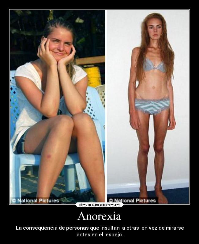 Anorexia - La conseqüencia de personas que insultan a otras en vez de mirarse
antes en el espejo.